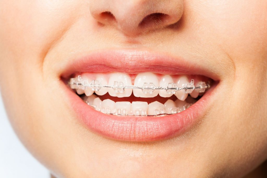 https://www.eastchestermeredental.ca/wp-content/uploads/2022/02/why-use-invisible-braces.jpg