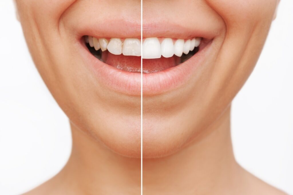 revitalize your smile how porcelain veneers can transform your teeth